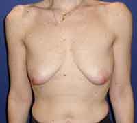 Подтяжка груди