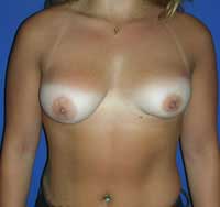 Асимметрия груди