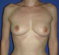 Асимметрия груди