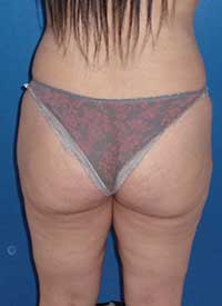 лифт ягодицы