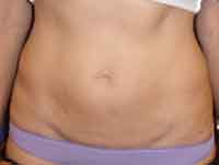 Tummy tuck