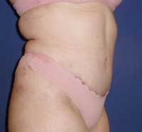 Пластика живота