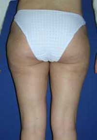 Липоскульптура