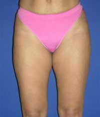 Липосакция