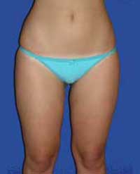 Липоскульптура