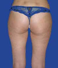 Липосакция