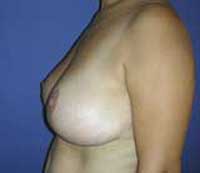 Уменьшение груди