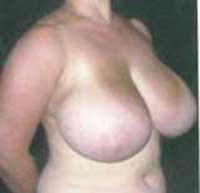 Уменьшение груди