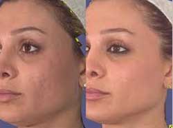 Ενέσεις υαλουρονικού οξέος