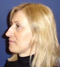 Ринопластика 