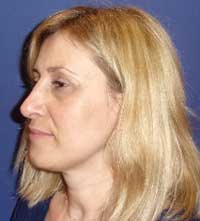 Пластика носовой перегородки