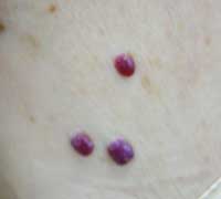 αιμαγγειωμα