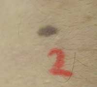 Диспластический невус